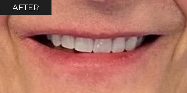 11-after