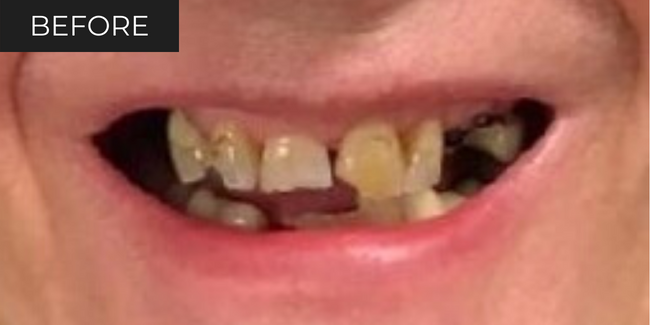 11-before