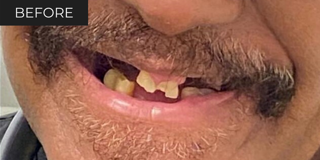 14-before