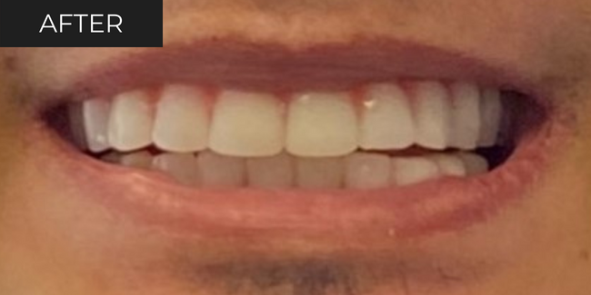 2-after