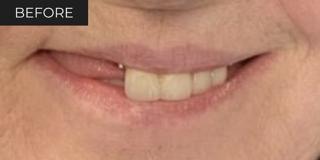 6-before