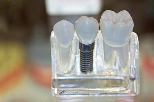 Dental Implants in Montclair
