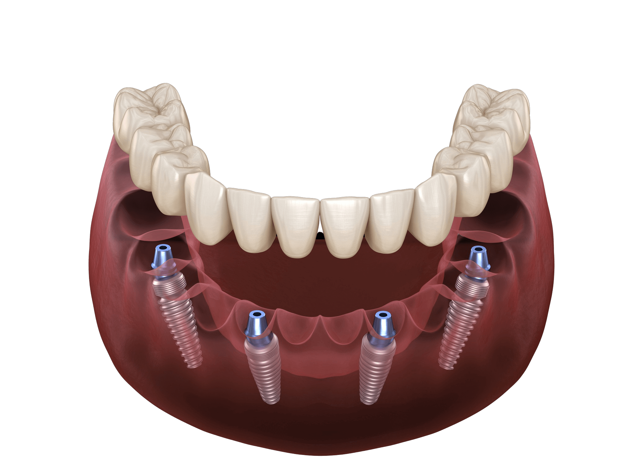 All-on-4 Dental Implants in Montclair, NJ