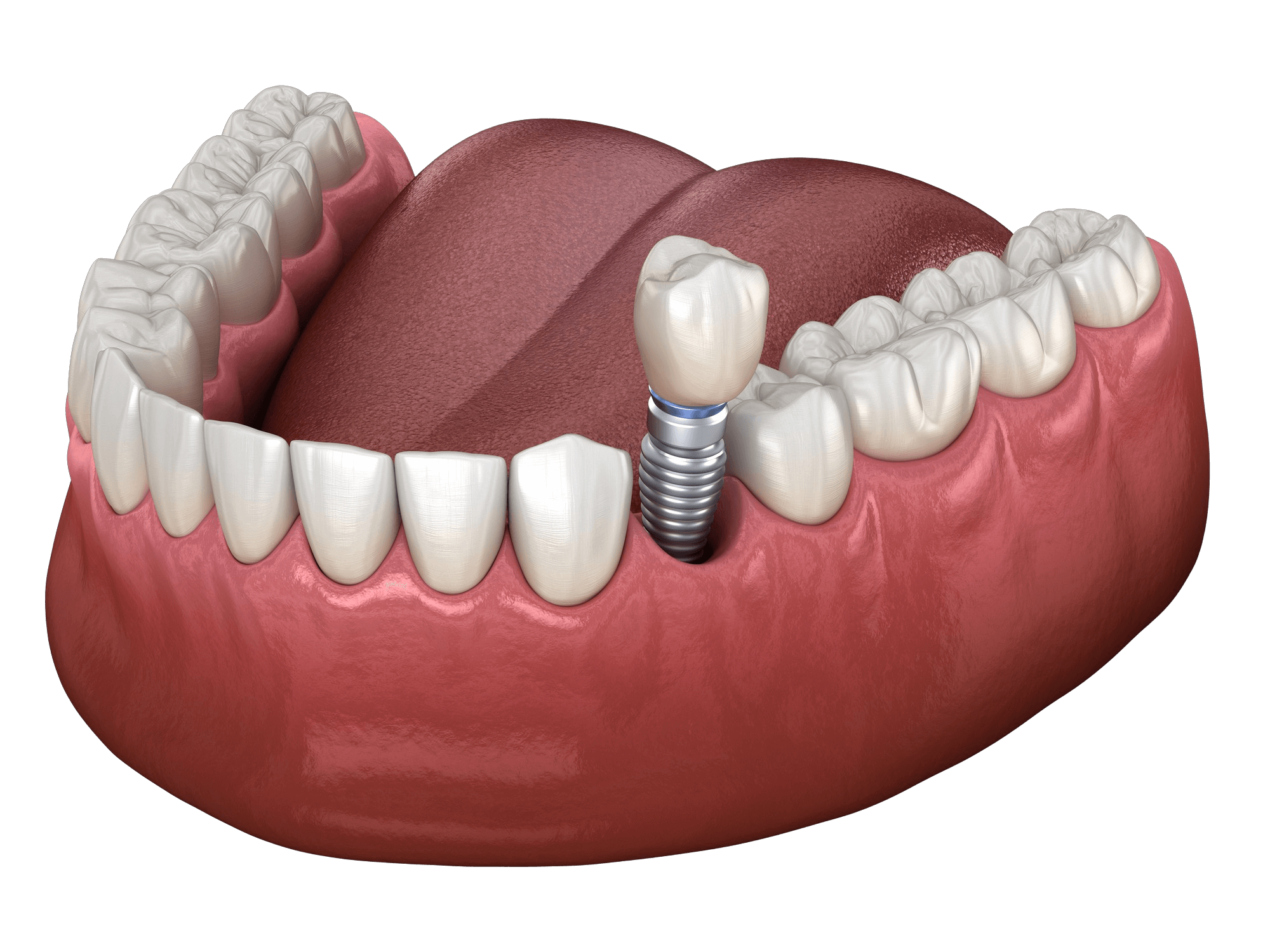 Single Dental Implants in Montclair, NJ