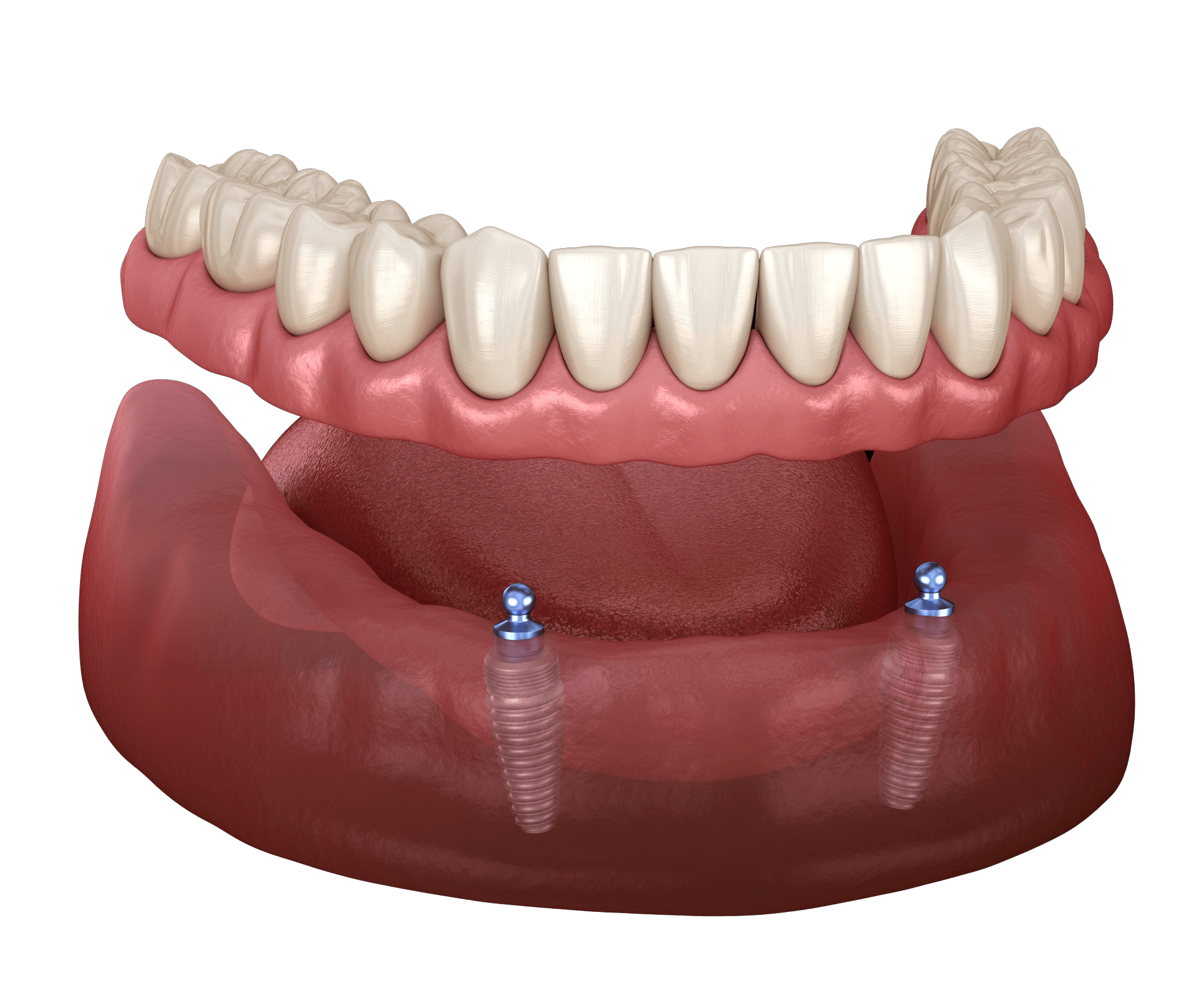 stabilized-dentures-best-dental-imlant-dentist-dental-implant-treatment-options