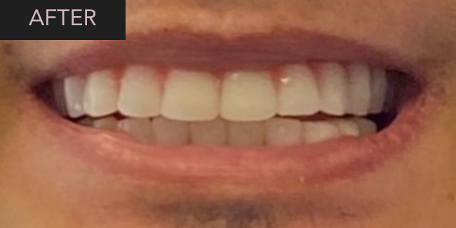 Montclair Dental Spa All-on-4 Before & After