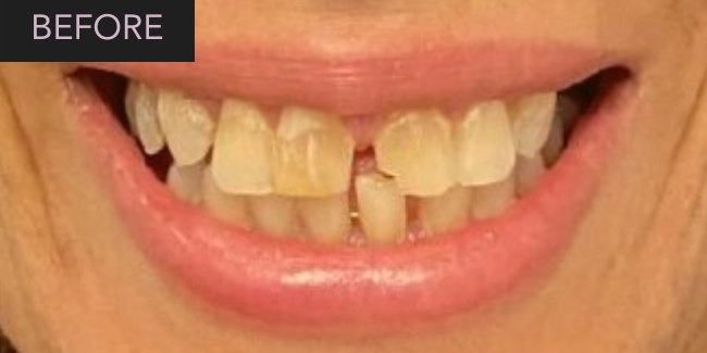 Montclair Dental Spa All-on-4 Before & After