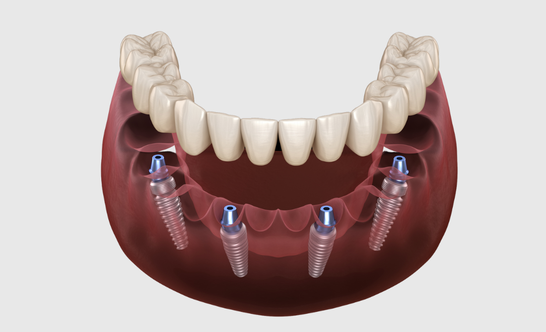 Dental Implants What Are All-On-4