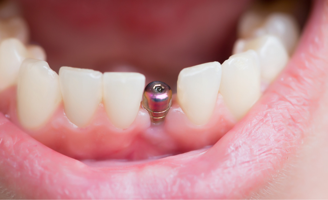 Dental implant in montclair nj