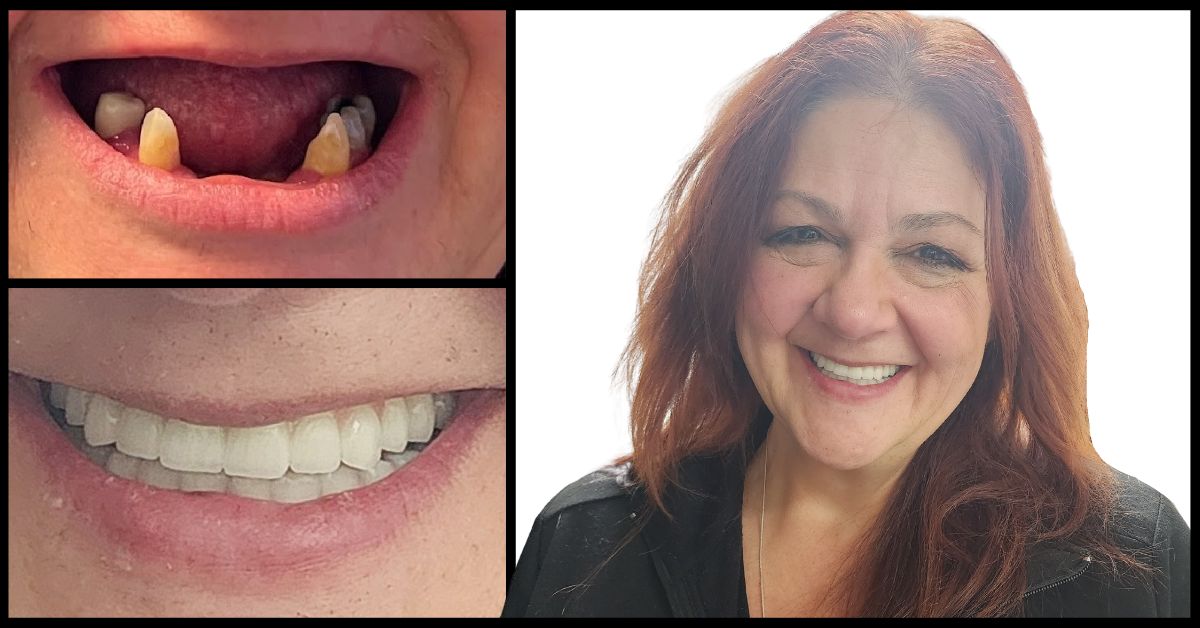 All on 4 Dental Implants Phoenix: A Game Changer for Missing Teeth