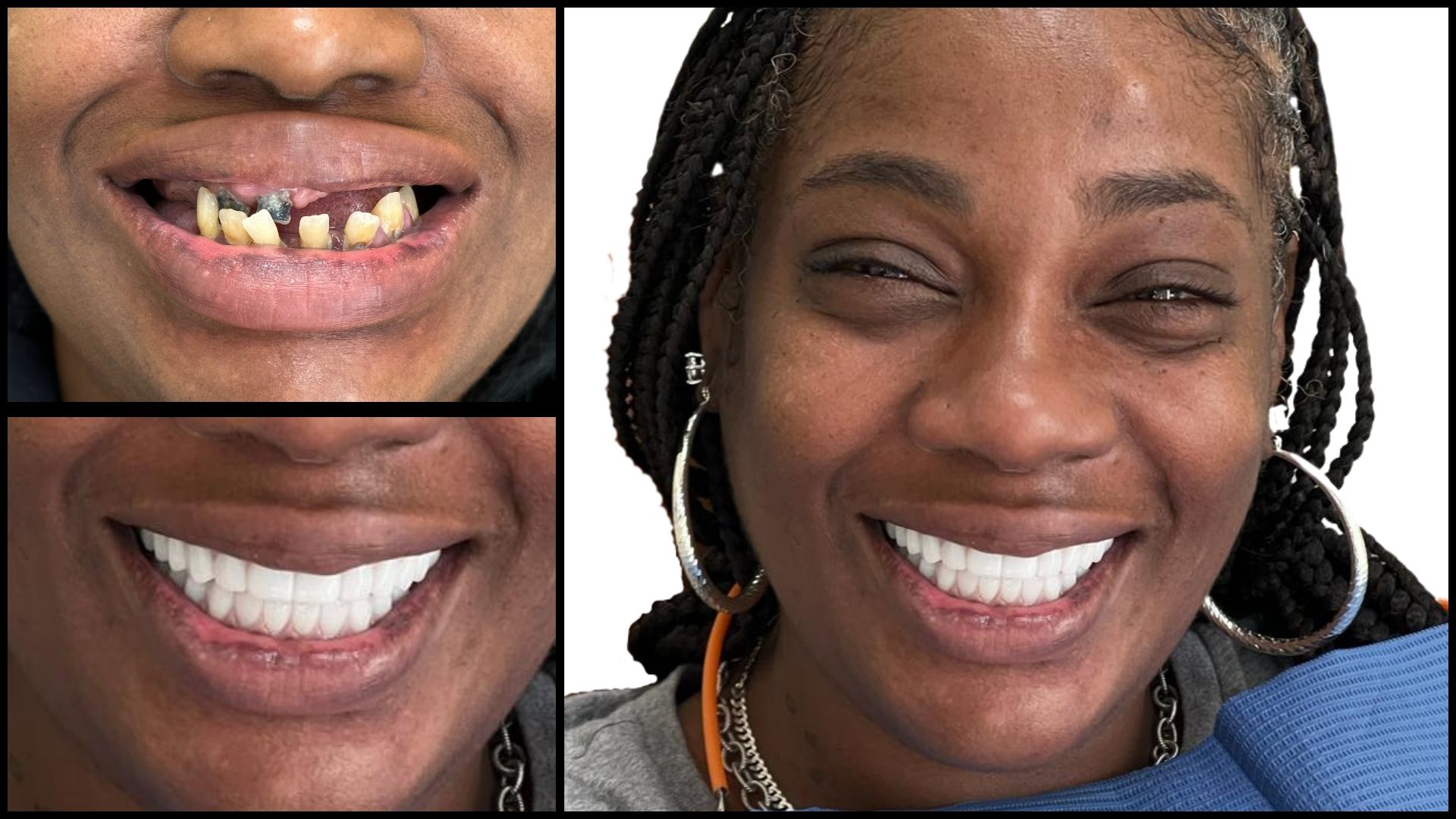 Before And After Images of Daisha All on 4 Smile Restoration